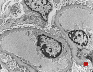 F,2y. | normal kidney